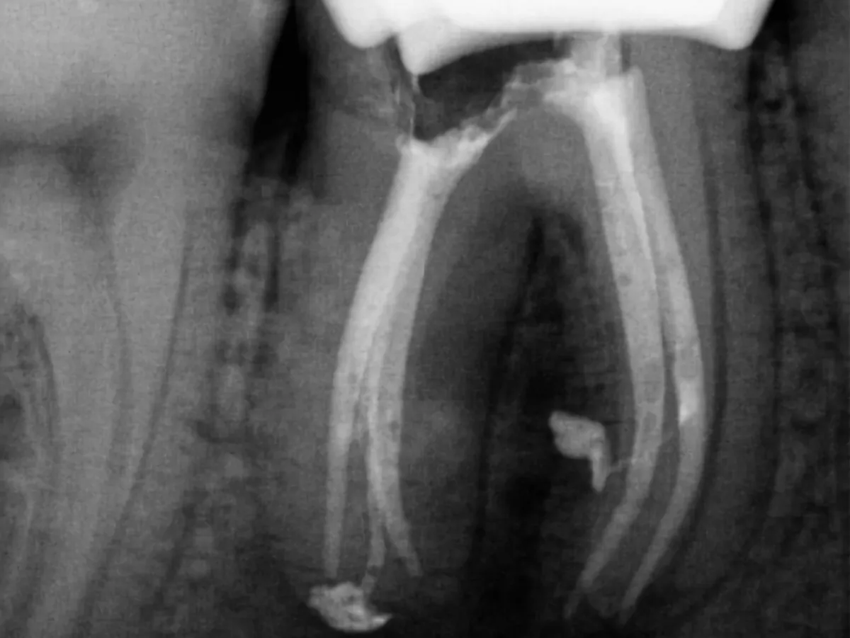 Procedura kliniczna w endodoncji — analiza trudnego przypadku.