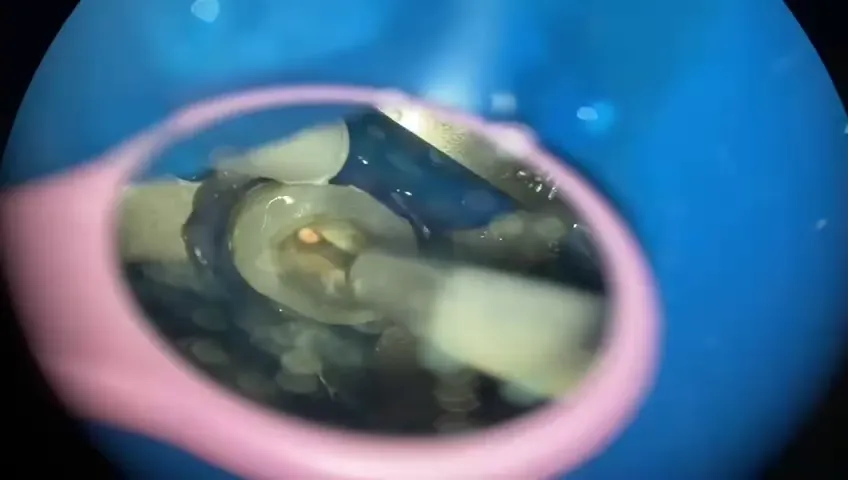 Analiza przypadku endodontycznego pod mikroskopem z dokumentacją RTG.